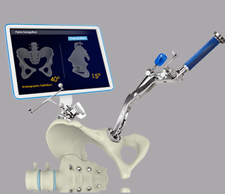 Robotic Guidance in Total Hip Arthroplasty American Hip Institute Research Foundation
